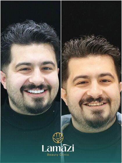 Results — Lamazi