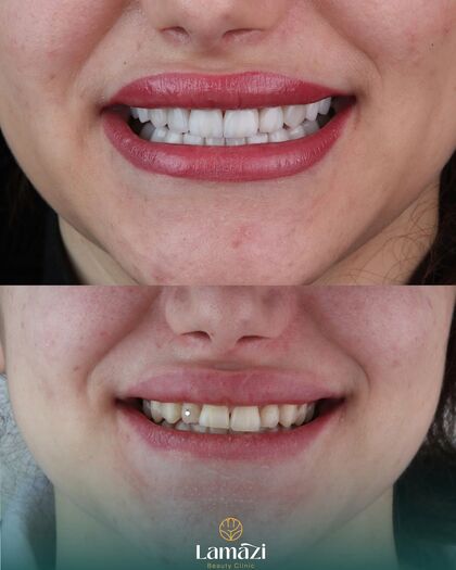 Results — Lamazi