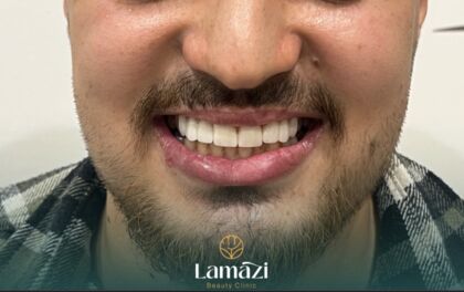 Results — Lamazi
